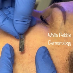 Are there any side effects of dermaplaning